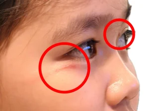 Redness and swelling near the eye caused by Paederus dermatitis from rove beetle