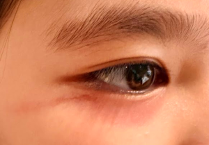 Emma's eye swelling from rove beetle dermatitis during HCMC trip